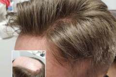 Haarsystem_1a